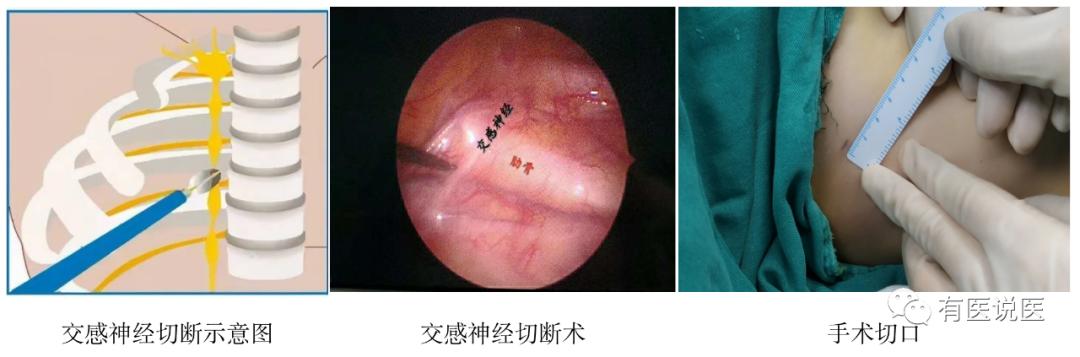 手汗症从什么年龄开始知道,健康科普手汗症你了解多少