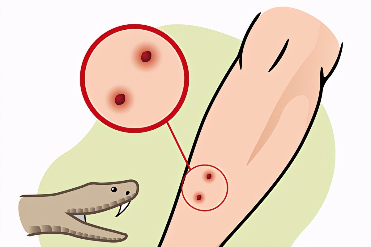 捡到眼镜蛇炖汤，剪掉的蛇头却突然“复活”，浙江老伯差点失明