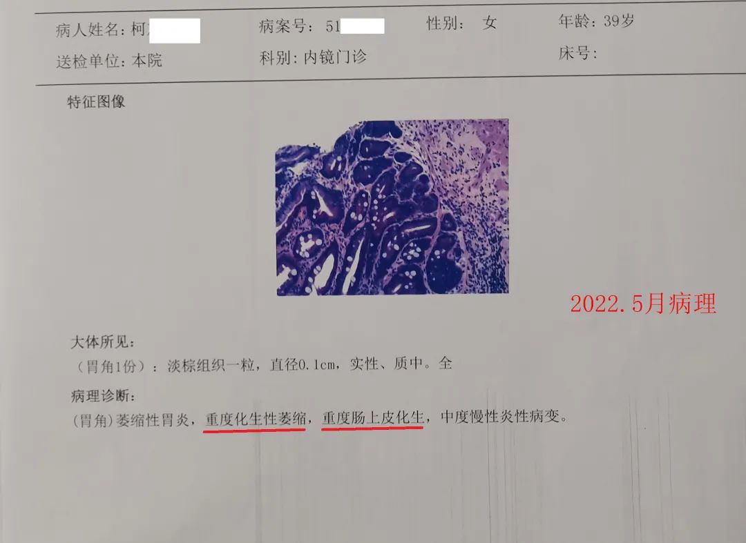 胃窦重度萎缩重度肠化多久会癌变,萎缩性胃炎重度肠化癌变几率