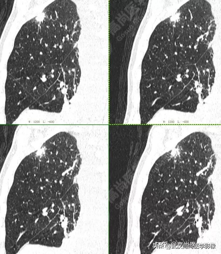 10毫米的肺结节恶性死亡率有多大,1厘米多的肺结节良性可能性多大