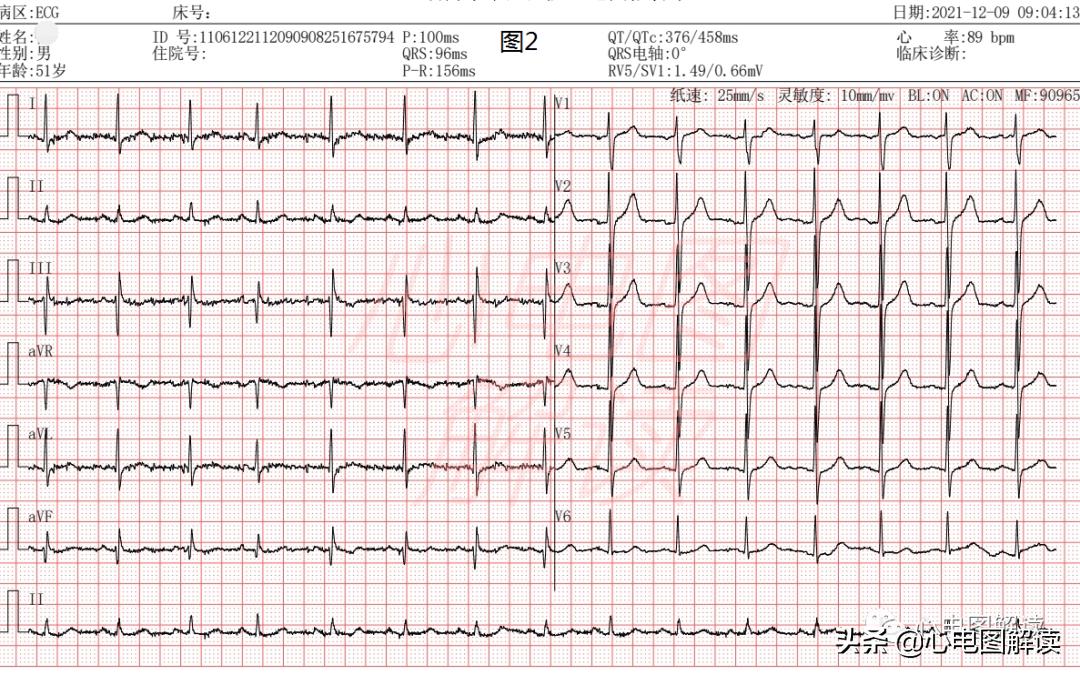 心电图房性心律窦性心律,房性心律与房性自主心律分类