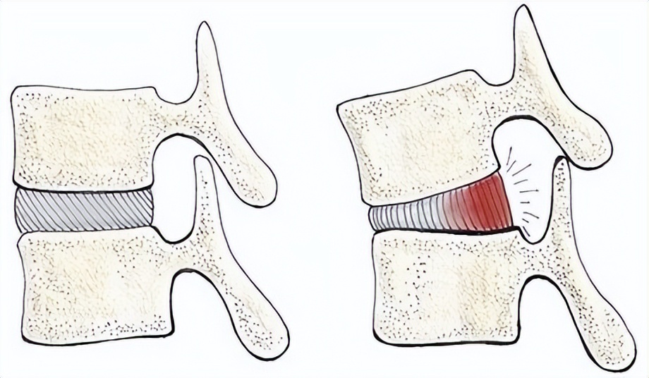 为什么戴护腰深蹲还是腰痛,深蹲腰部受伤自测