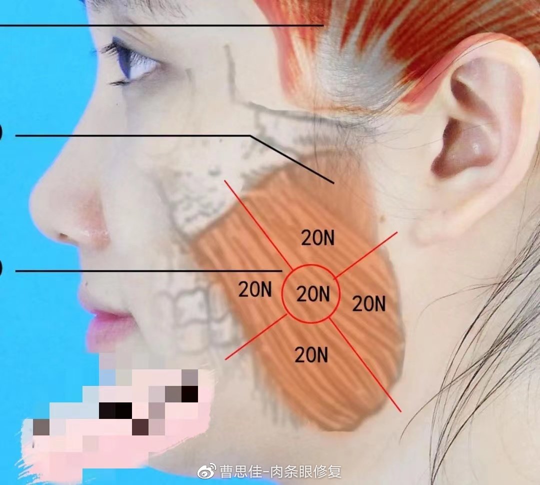 瘦脸针后咬肌为什么更大了,打完瘦脸针咬肌鼓包正常吗