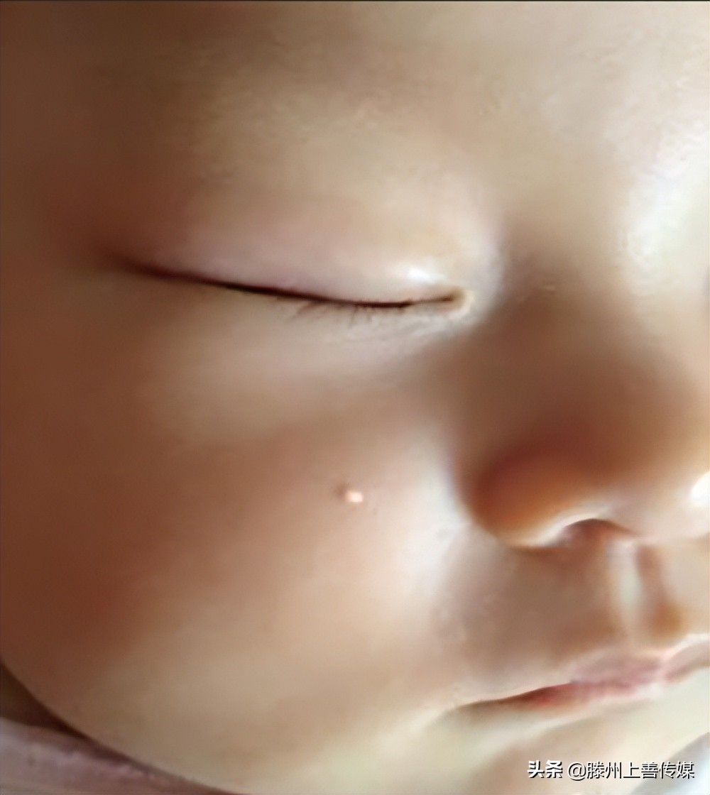 长了脂肪粒觉得眼前模糊正常吗,为什么脂肪粒会越长越多