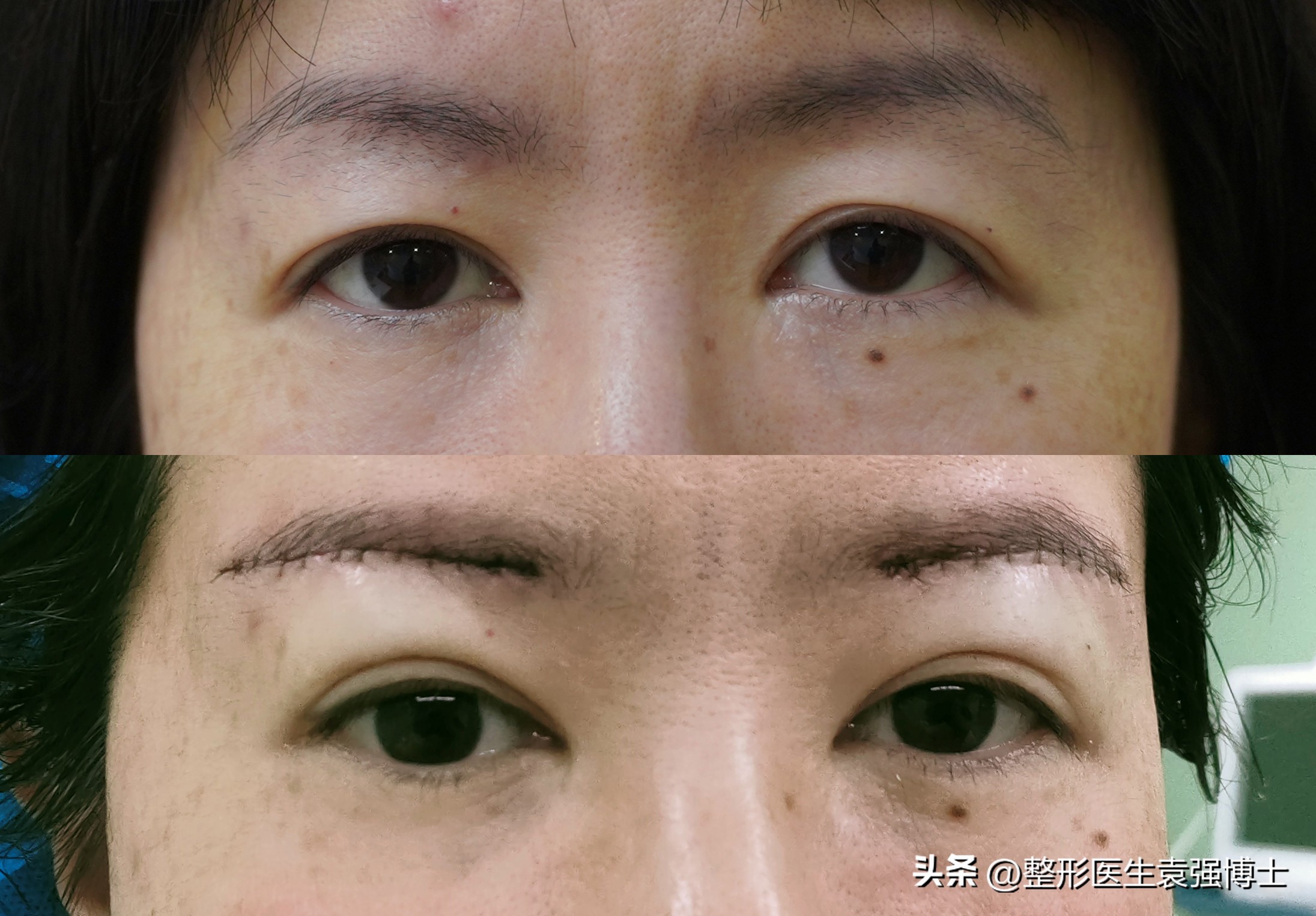 上眼皮耷拉、三角眼、眼皮松，医生说这两种方法很实用