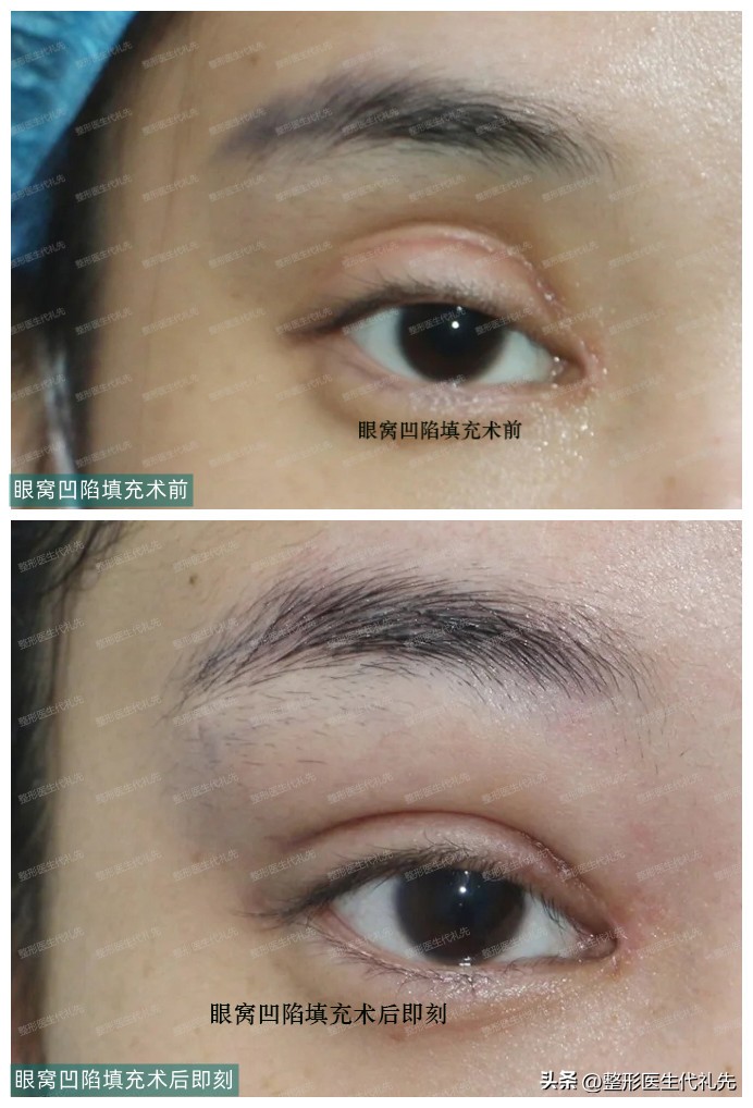 眼窝凹陷睡觉可以恢复吗,长时间熬夜下眼窝凹陷可以恢复吗