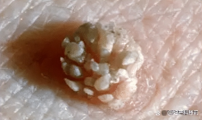 体检中发现HPV阳性，是得性病了吗？