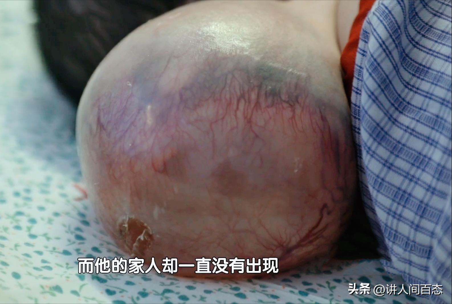 被丢在桥洞下的孩子后续,孩子被遗弃后脑长肿瘤