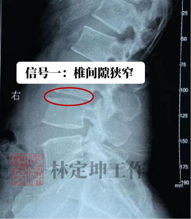 中医正骨腰椎疼痛,腰痛针灸和贴膏药哪个效果好