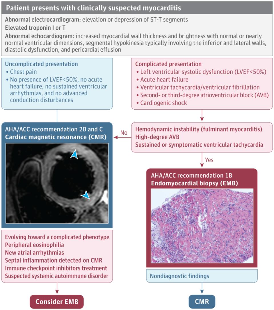 JAMA综述：急性心肌炎的诊治进展