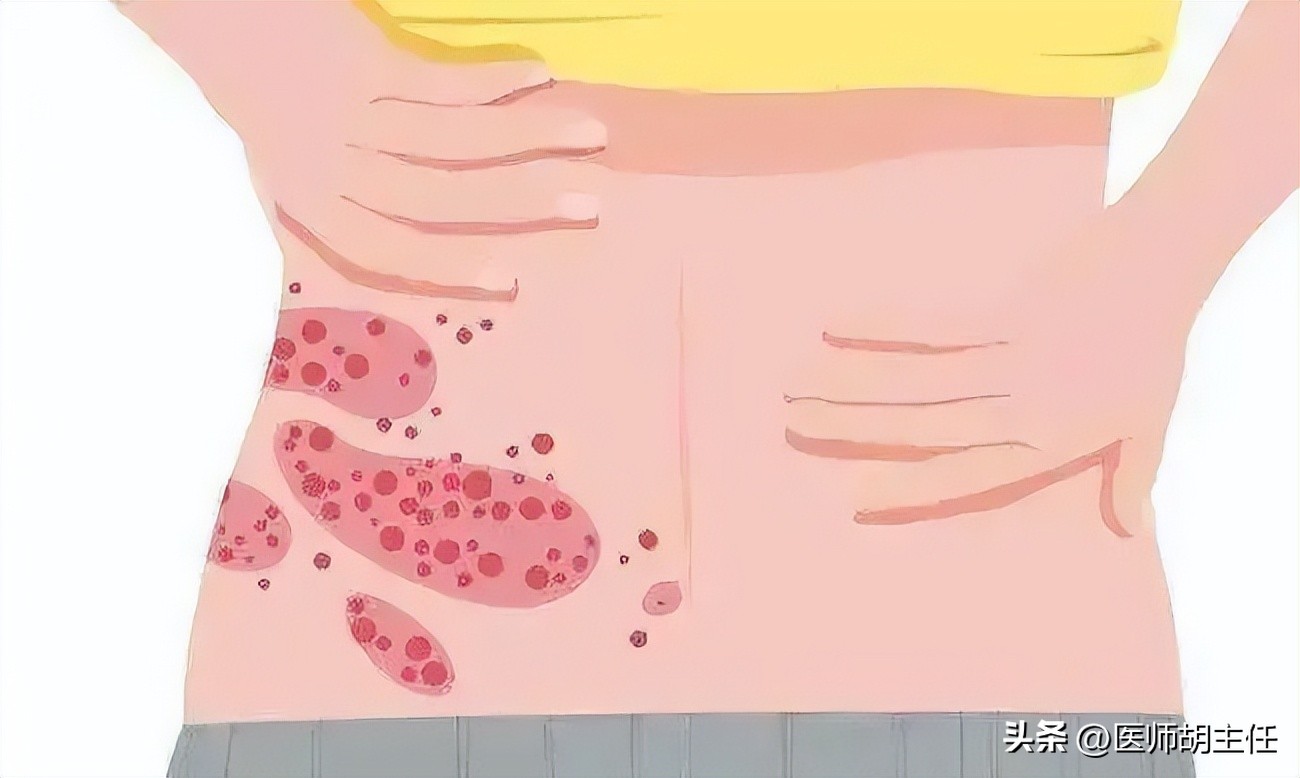 带状疱疹缠腰蛇为什么会头痛,蛇缠腰带状疱疹怎么才算治好