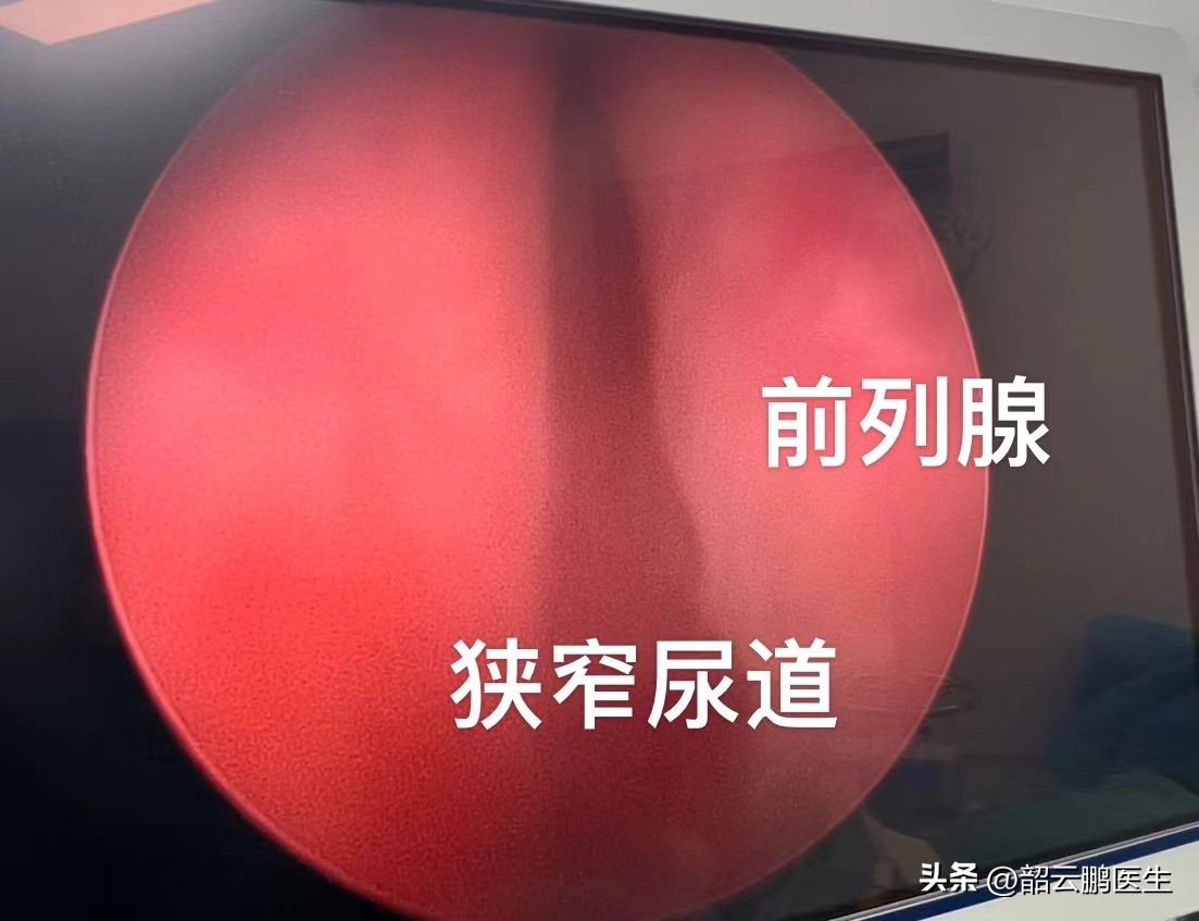 前列腺水蒸气消融术的缺点是什么,前列腺增生热疗消融手术靠谱吗