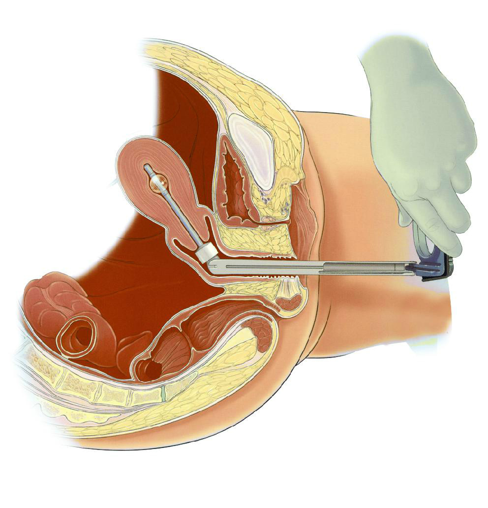 单孔腹腔镜的技术优势有哪些,有关妇科单孔腹腔镜手术的科普