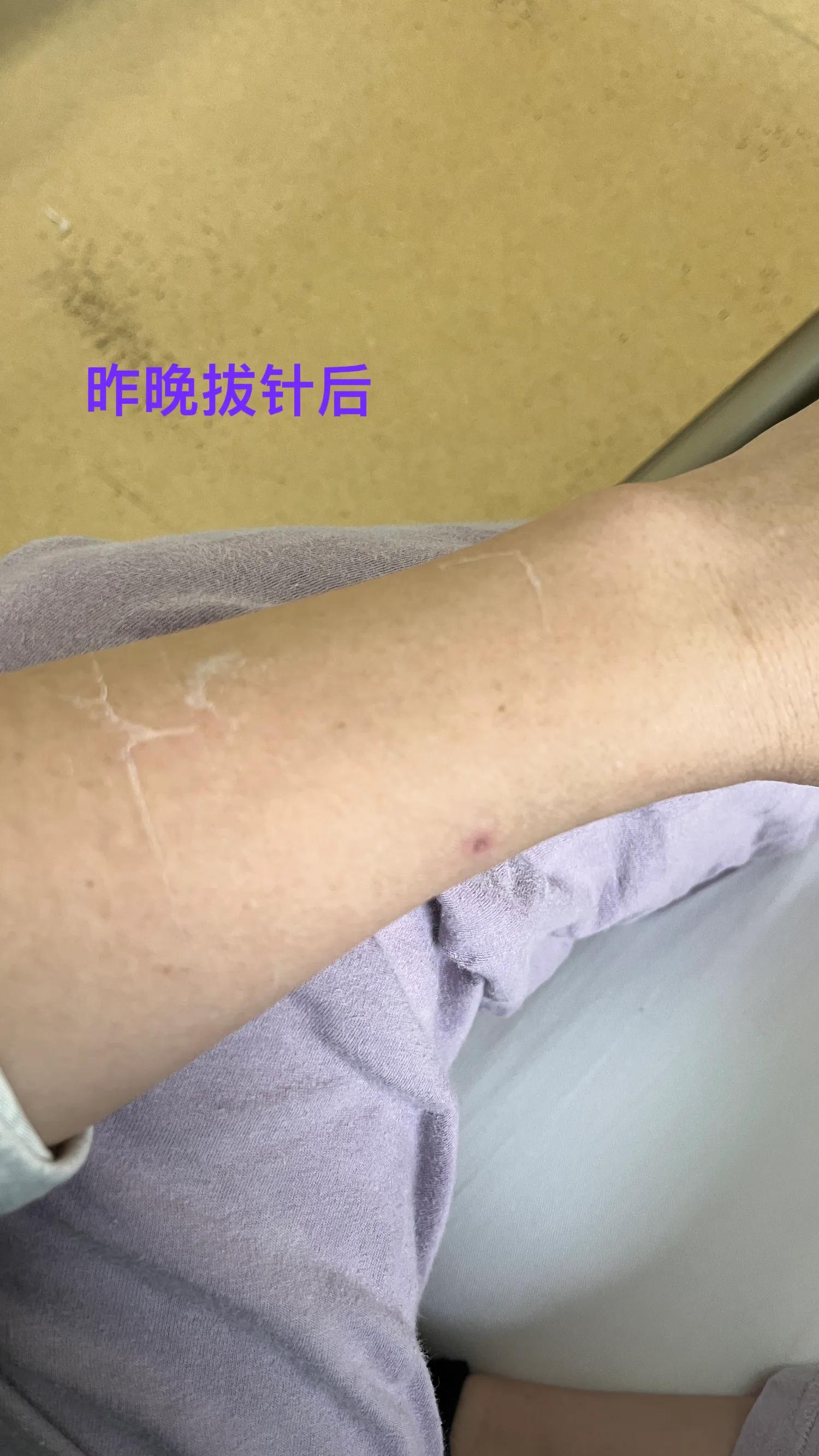 从早上不到十点打点滴到现在（晚八点）！本来是两瓶...