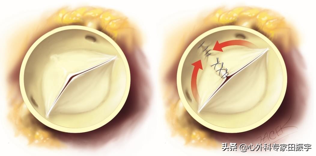 最先进的主动脉瓣二瓣叶畸形修复术（2020版）