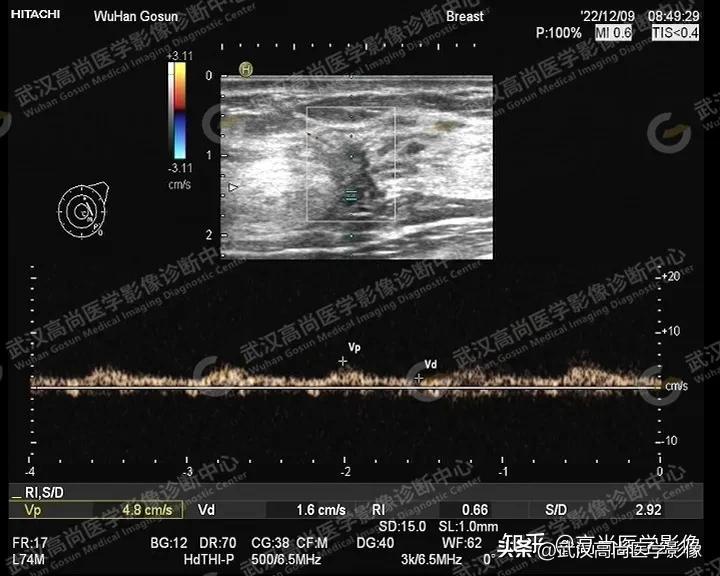 乳腺超声病例,乳腺肿块巨大超声结果4a