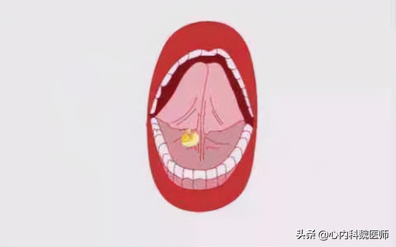 心肌缺血吃什么药效果更好,心肌缺血吃什么药效果比较好