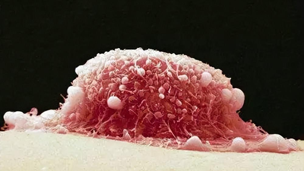 54岁女子确诊外阴癌，追悔莫及！提醒女性：下身4种异常，别大意