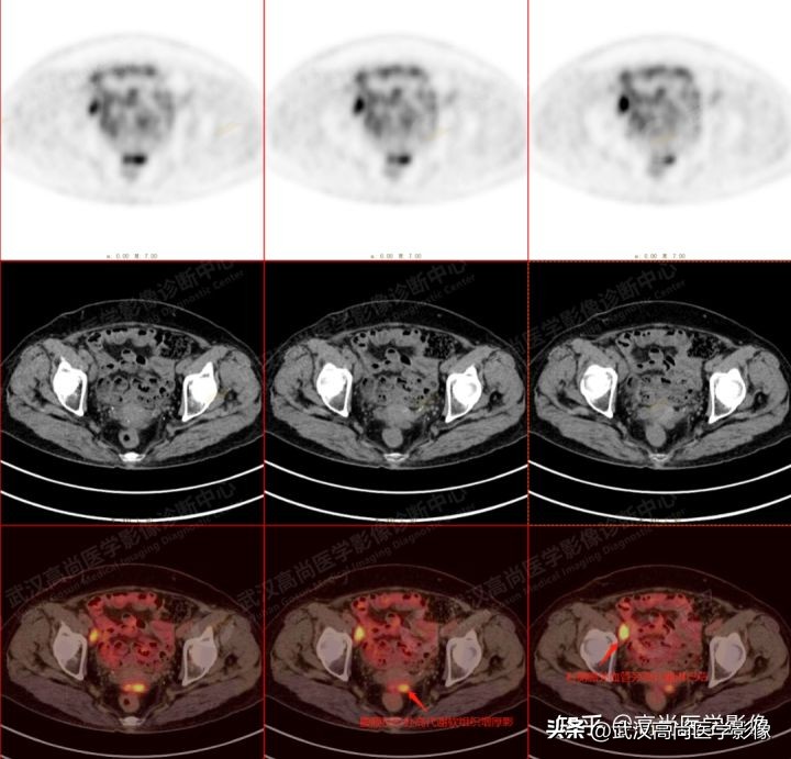 罕见卵巢恶性肿瘤,肿瘤罕见病