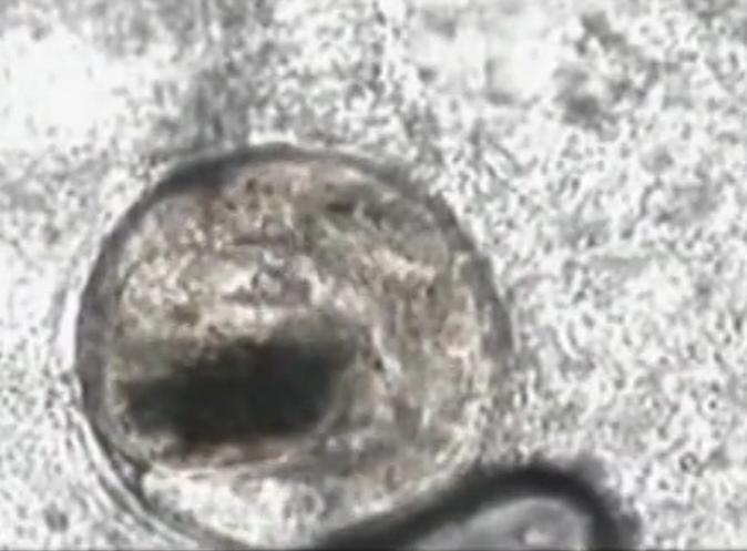 故事：湖北55岁男子病从口入，孕出成千上万虫卵，肚子竟成虫窝