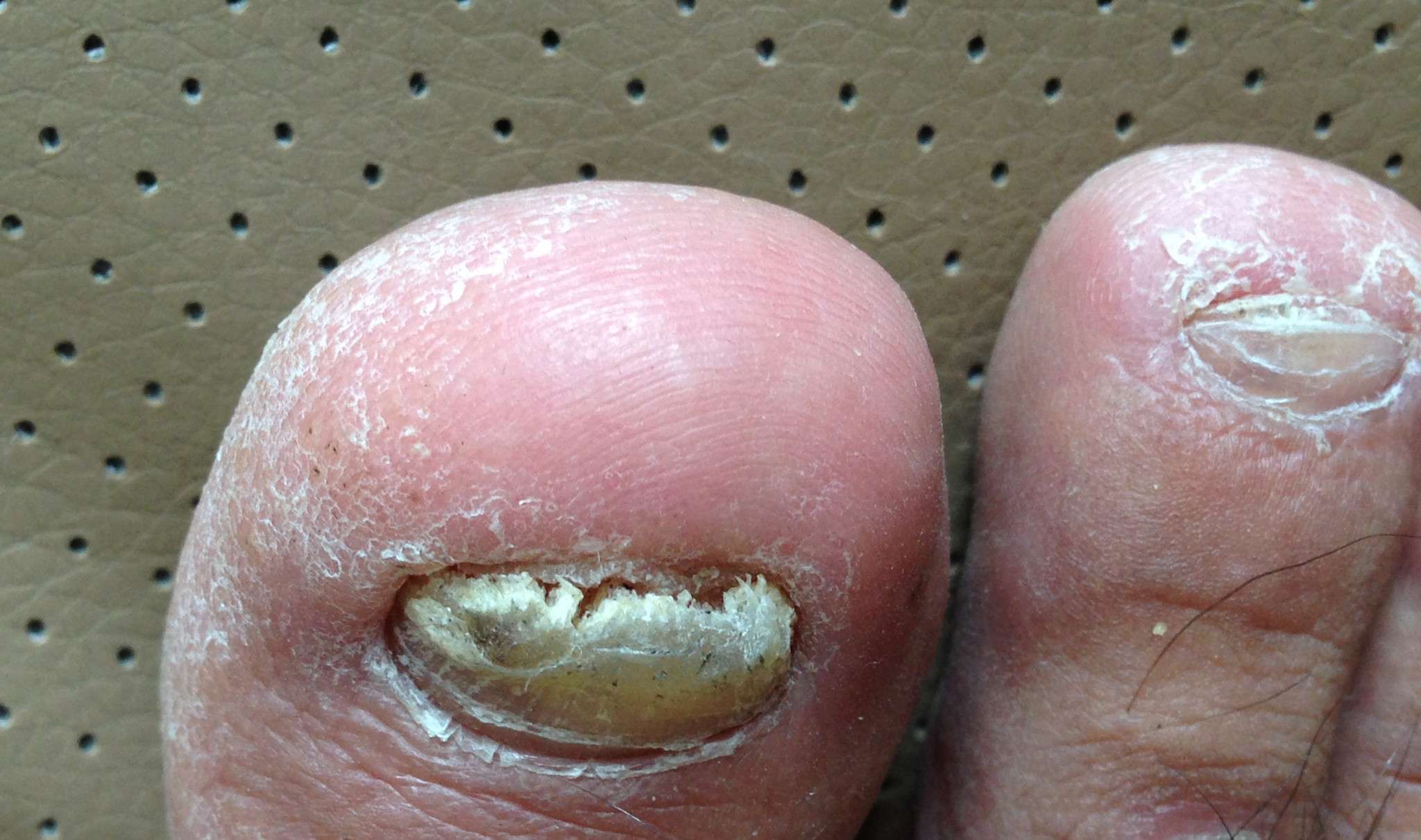 灰指甲到底怎么才能彻底治好,灰指甲怎么治最好的偏方大全