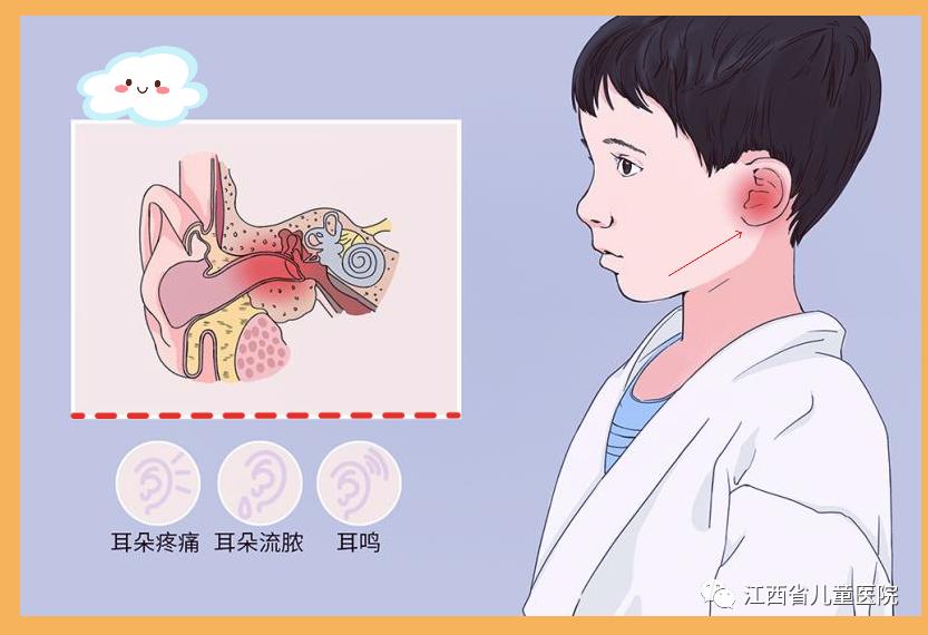 急性中耳炎儿童一边耳朵疼,宝宝急性中耳炎耳朵疼怎么办