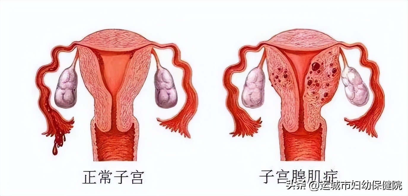 科普｜带你认识困扰女性的子宫腺肌症