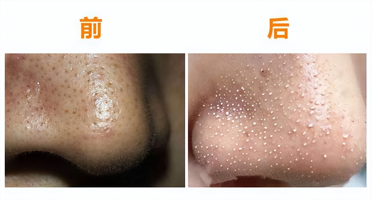 眉心鼻翼和下巴长粉刺为什么,鼻头上起粉刺什么原因引起的图片