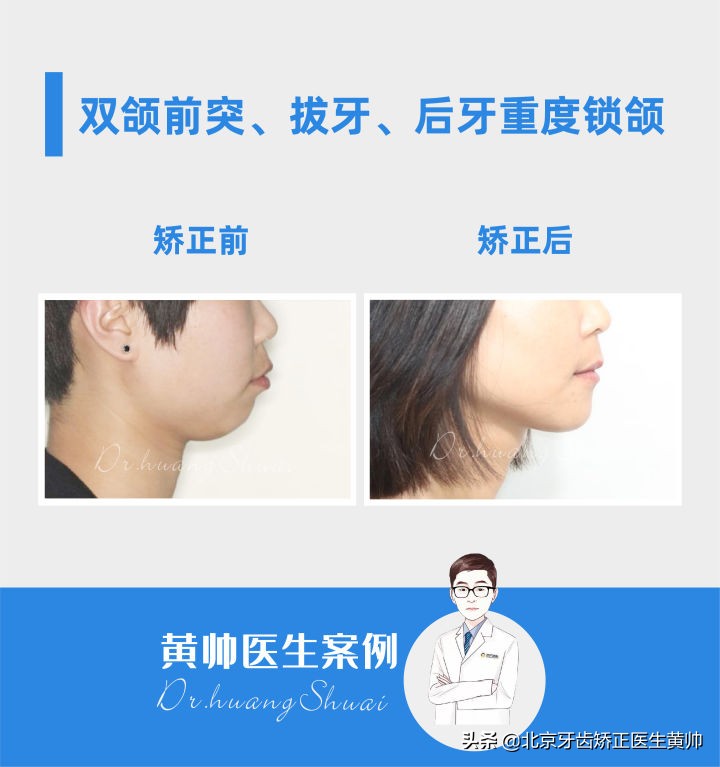 嘴凸的人怎么笑起来好看,嘴型比较凸的人怎么改善