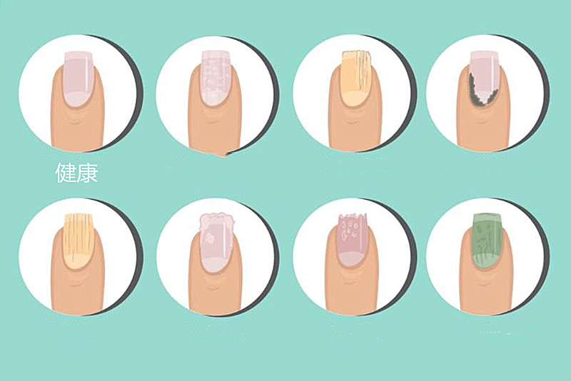 手指肿胀，弯曲就痛，指甲变脆，容易被误诊的银屑病关节炎