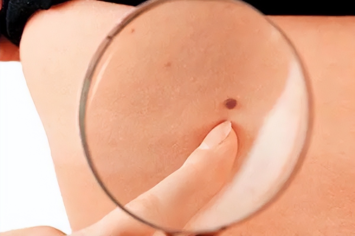 痣提前弄掉会导致黑色素瘤吗,痣和黑色素瘤哪个可以抠掉