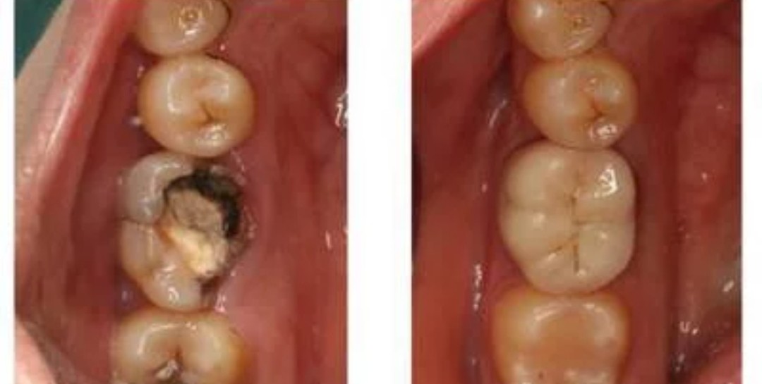 根管治疗后牙齿一直不舒服,根管治疗后牙齿需要全冠吗