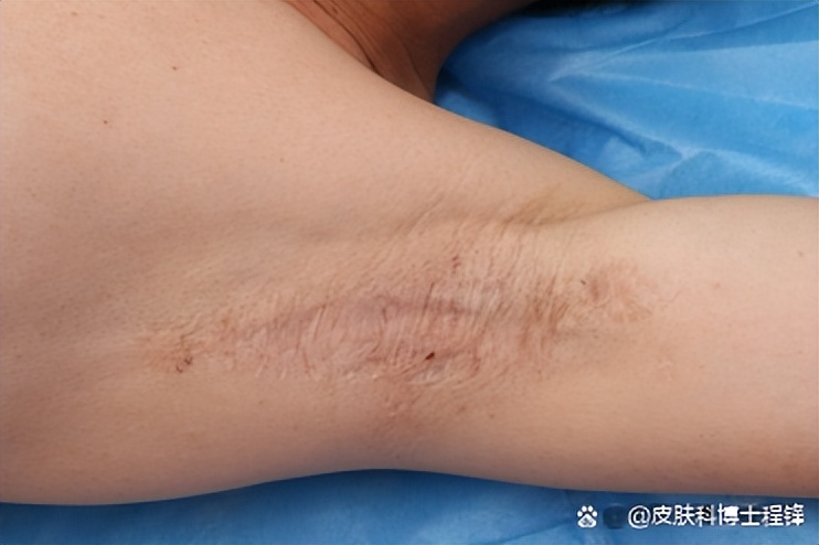 做完腋臭微创手术复发几率,腋臭手术后复发了怎么调理排毒