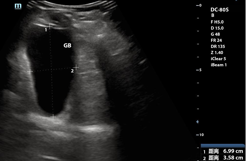 超声所见正常范围准确吗,超声看不清楚