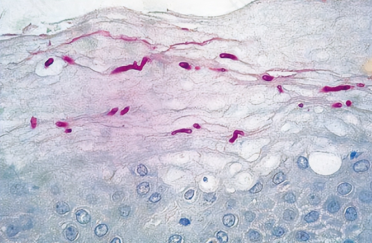 脚气到底是怎么引起的,脚气是怎么引起的用什么药治疗