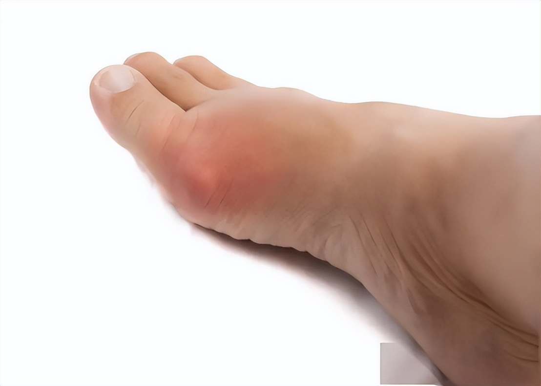 痛风是一个脚趾头痛还是全脚痛,痛风前兆脚趾关节疼饮食