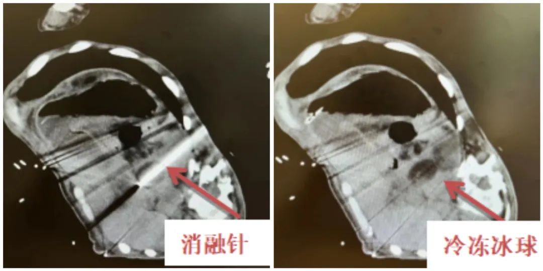 西安大兴医院一根针治肿瘤,恶性肿瘤西安医院