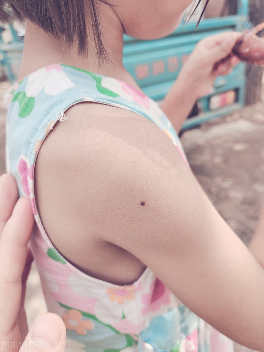 如何分辨脸上的凸痣是良性或恶性,如何来辨别良性痣和恶性痣