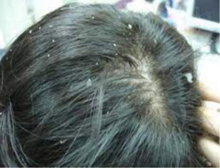 头皮屑特别多怎么去除最简单方法,头皮屑又多又痒怎么去除最有效