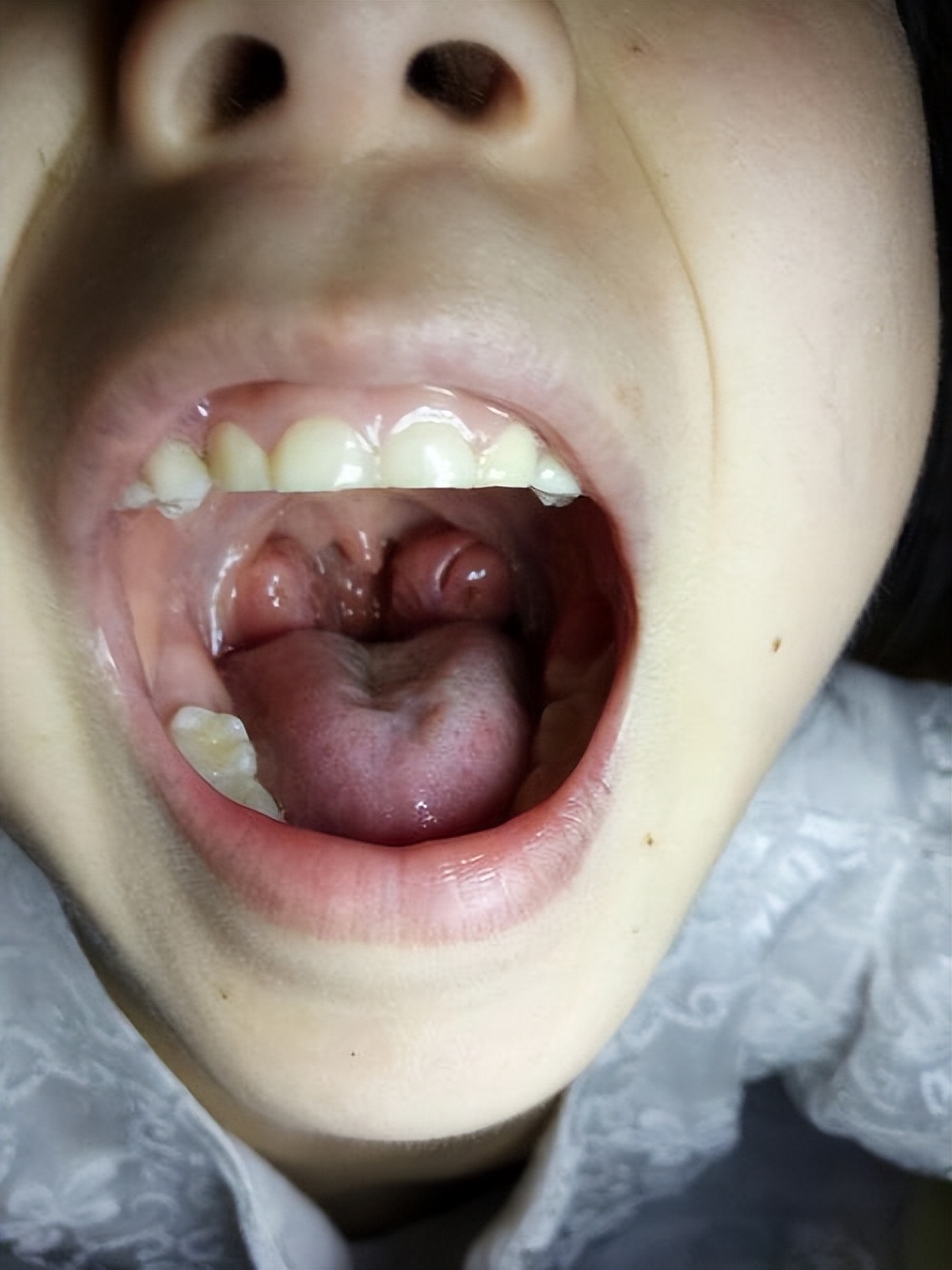 化脓性扁桃体炎中医怎么治,儿童化脓性扁桃体炎中医怎么治疗