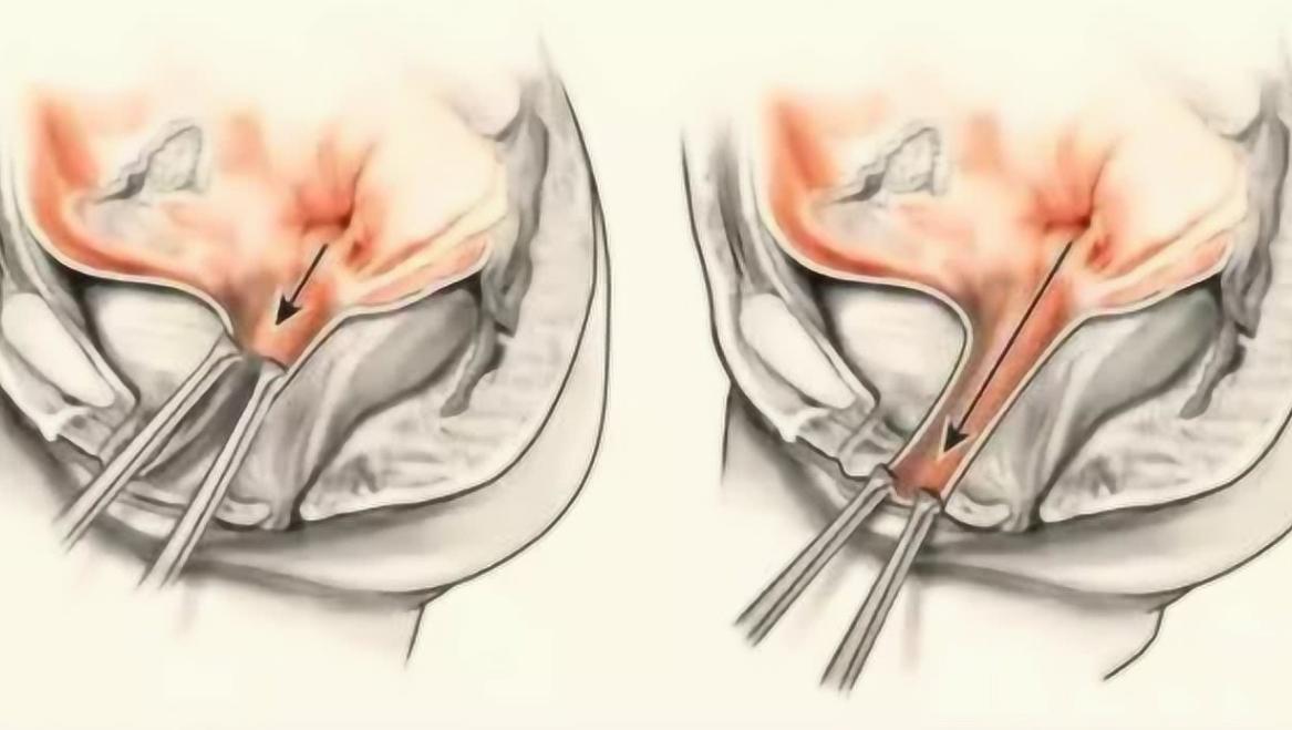 没有阴道的“石女”是怎么回事?还能过夫妻生活吗?答案让人意外