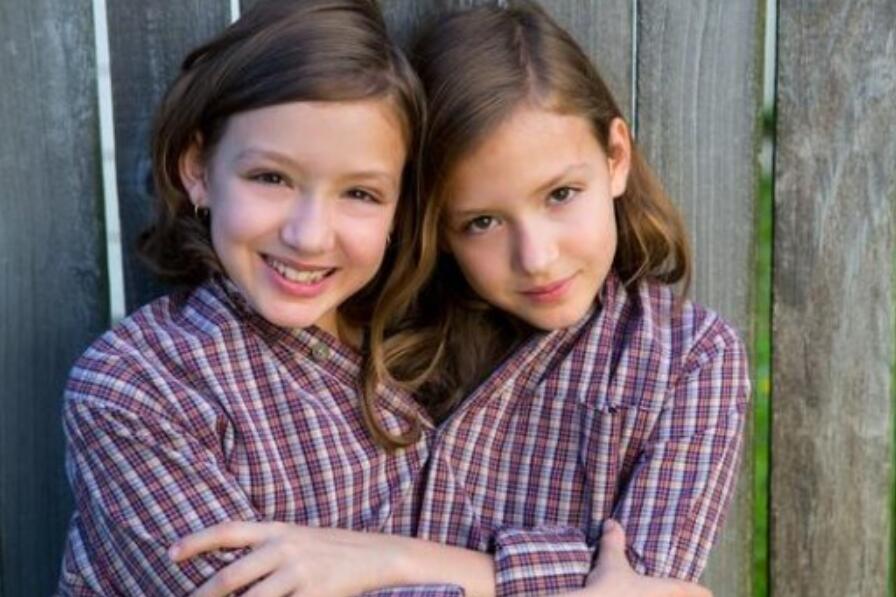 连体人该怎么结婚生子,邦克兄弟连体人