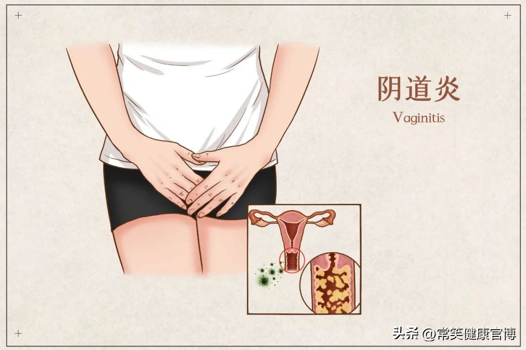 念珠菌性阴道炎症状及治疗药物,念珠菌阴道炎怎么治疗