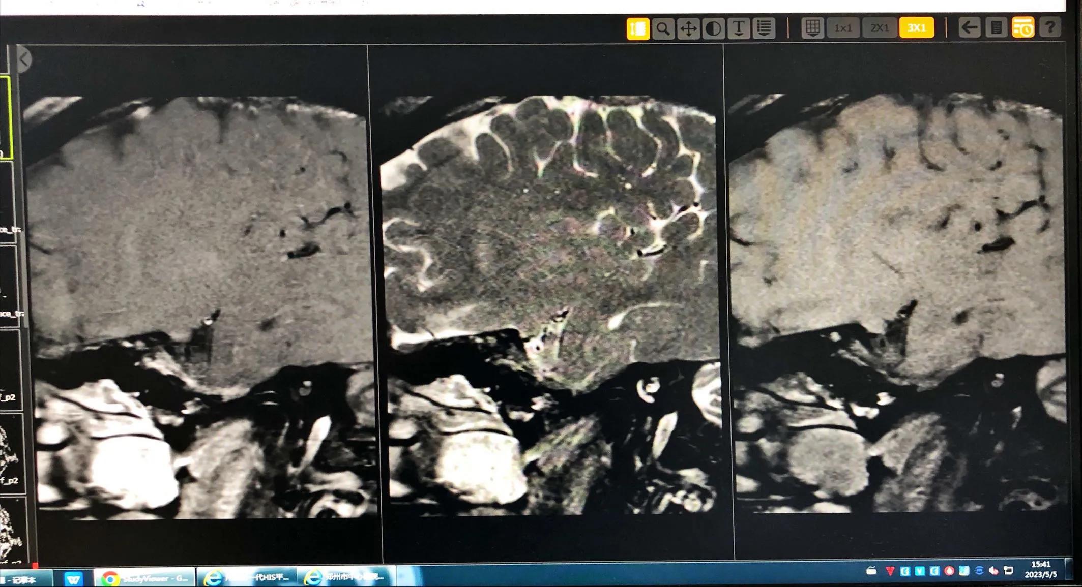 血管健康日为什么定在5月18日,血管的健康日