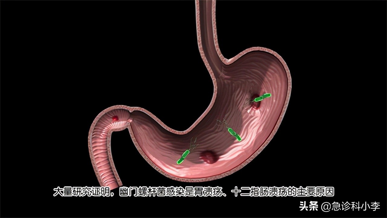 幽门螺杆菌导致的胃癌如何治疗,幽门螺杆菌根除了还会得胃癌吗