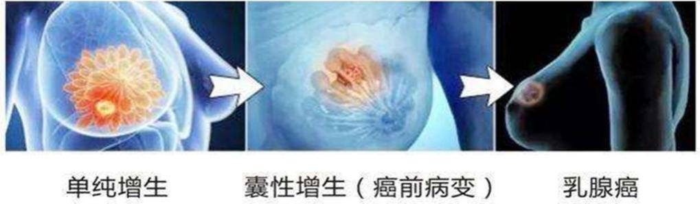 关爱女性健康｜体检单上的“乳腺增生”到底是什么？