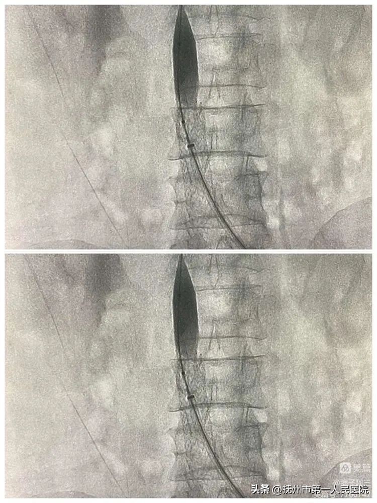 布加氏综合征介入治疗的注意事项,布加综合征介入手术加支架的利弊