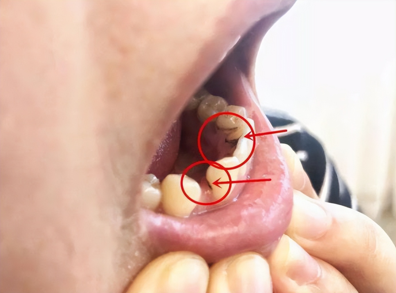 抽烟时间越长牙越黑?这些小众真神了,操作好瞬间黑牙变白牙!