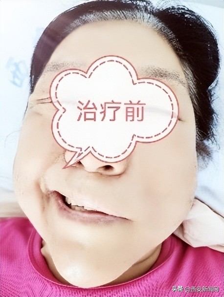 重症难治性面瘫致“面目变形”中西医治疗成功“矫面”