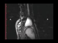 手指掰出咔咔声会得关节炎吗,关节掰得咔咔响会导致关节炎吗